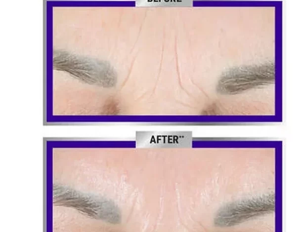 Beauty buffs praise award-winning sagging forehead cream said to work ‘magic’